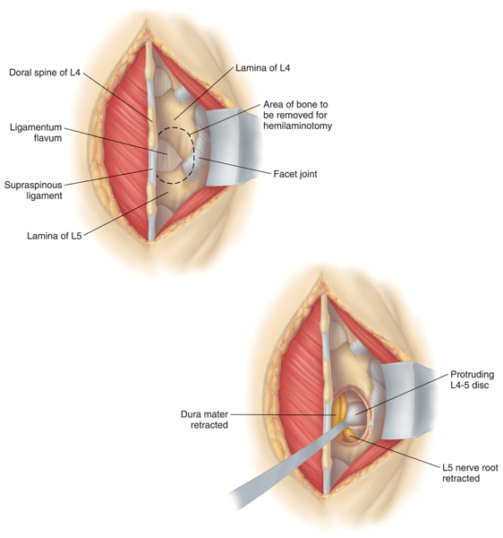 Lumbar discectomy Lumbar discectomy