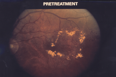 Macular Edema (Diabetic Retinopathy) Macular Edema (Diabetic Retinopathy)
